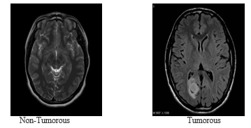 Brain Tumor Detection